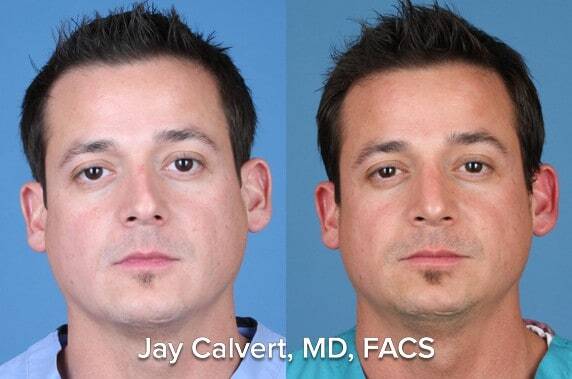 rib graft rhinoplasty for men results