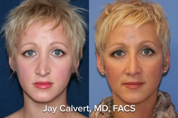 rib graft rhinoplasty results