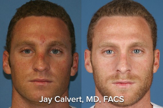 rib graft rhinoplasty for men results