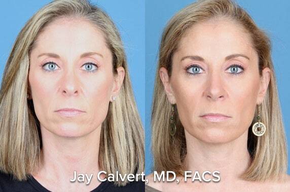 rib graft rhinoplasty results